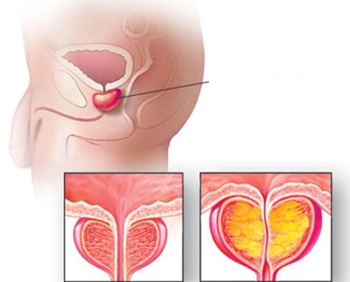 Location of the prostate, normal prostate and enlarged chronic prostatitis