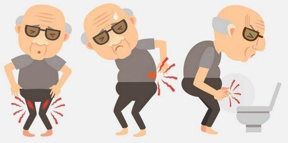 Symptoms of prostatitis